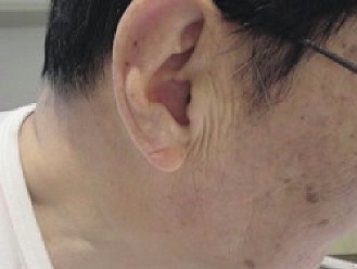 如果肥胖的人，耳垂又有如圖中的橫紋，極可能有心血管疾病。