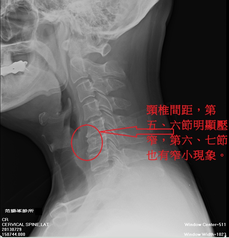 我的頸椎20130729-02.jpg