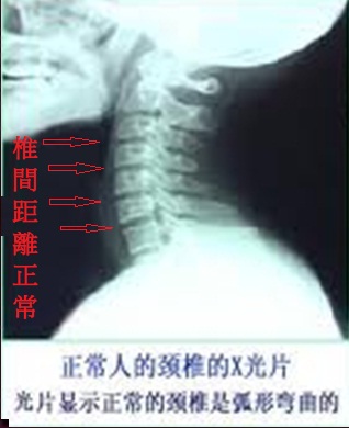 正常人的頸椎02.jpg