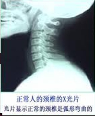 正常人的頸椎.jpg