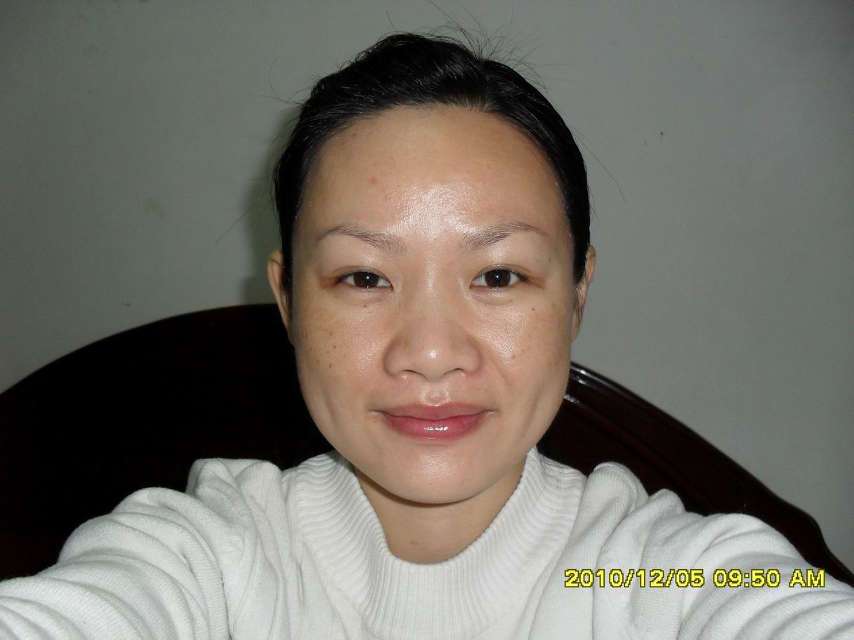 今年开始脸颊上长了很多的斑和点