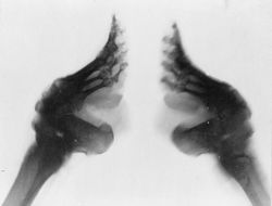 250px-Bound_feet_%28X-ray%29.jpg